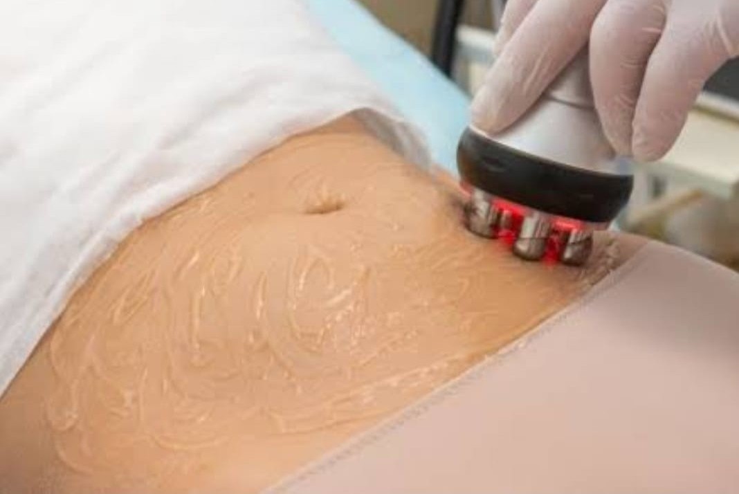 Radio Frequency handpiece being used for non-invasive fat removal and body contouring