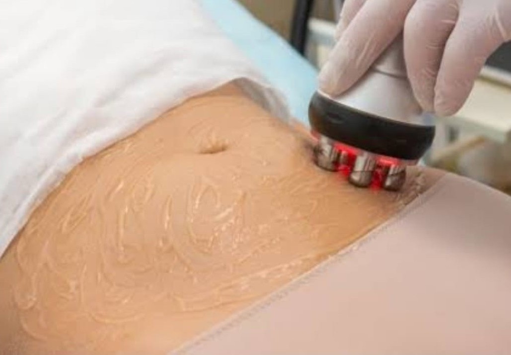 Radio Frequency for Fat Removal