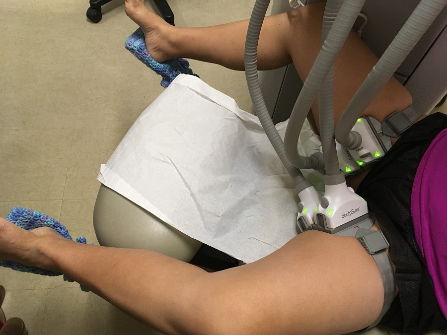 SculpSure for Thigh Fat