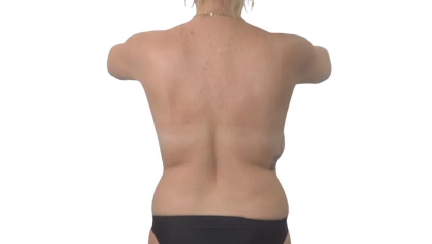 Abdomen before EMS Zero muscle toning