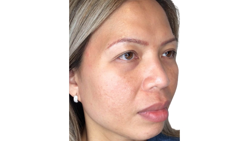 Clear and smooth skin after laser therapy