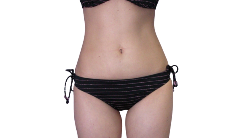Body after SculpSure treatment showing visible fat reduction